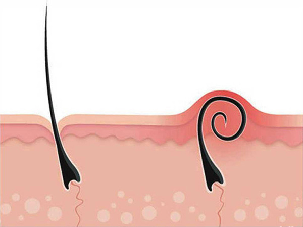 Pilonidal Sinüs (Kıl Dönmesi) Nedir?