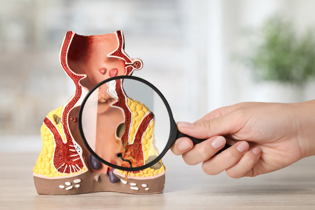 Anatomik model üzerindeki fistül incelemesi