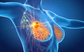 MEME HASTALIKLARI TAKİBİ VE CERRAHİSİ